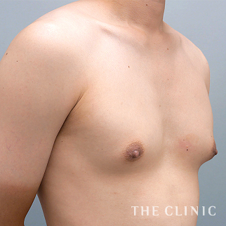 女性化乳房のベイザーのモニター(男性23歳)術前症例画像