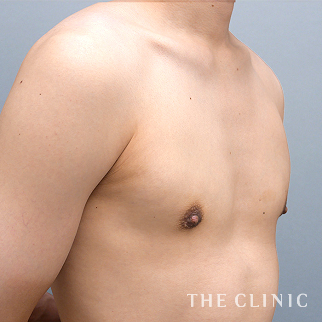 女性化乳房のベイザーのモニター（男性23歳）術後症例画像