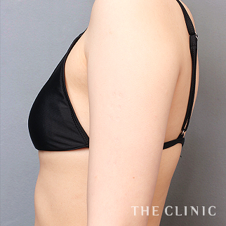 二の腕のベイザーのモニター(男性19歳)術前症例画像