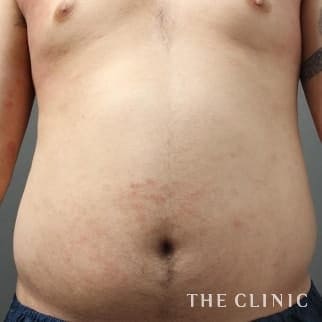 腹部のベイザーのモニター（男性33歳）術前症例画像
