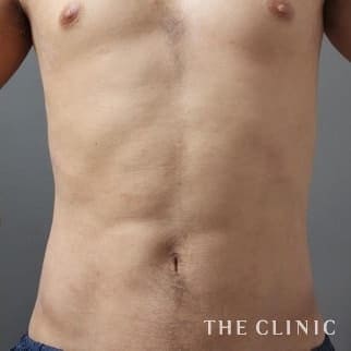 腹部のベイザーのモニター(男性33歳)術後症例画像