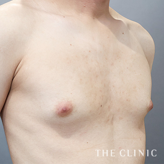 女性化乳房のベイザーのモニター（男性21歳）術前症例画像