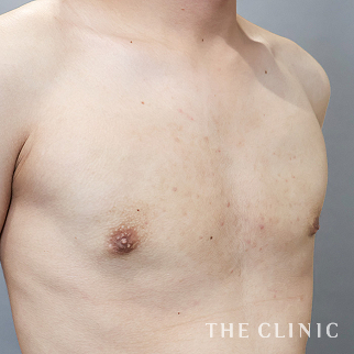 女性化乳房のベイザーのモニター(男性21歳)術後症例画像