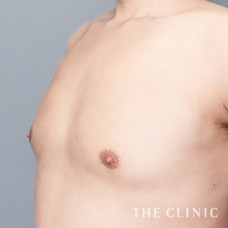 女性化乳房のベイザーのモニター(男性30歳)術後症例画像