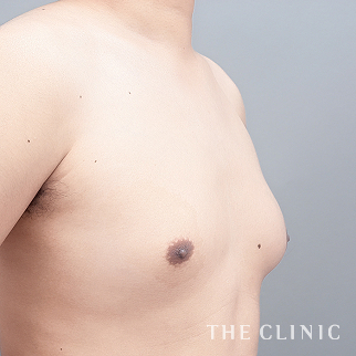 女性化乳房のベイザーのモニター（男性29歳）術前症例画像
