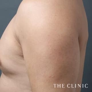 上腕のベイザー4Dスカルプトのモニター(男性42歳)術前症例画像