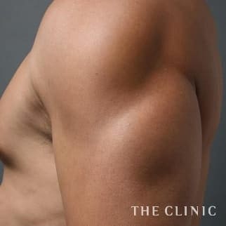 上腕のベイザー4Dスカルプトのモニター(男性42歳)術後症例画像