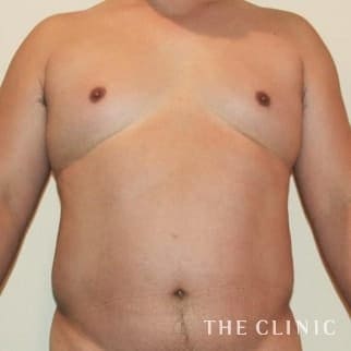 SIXPACK 陰影のある腹筋のベイザー4Dスカルプトのモニター(男性46歳)術前症例画像