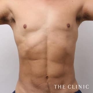 SIXPACK 陰影のある腹筋のベイザー4Dスカルプトのモニター(男性46歳)術後症例画像