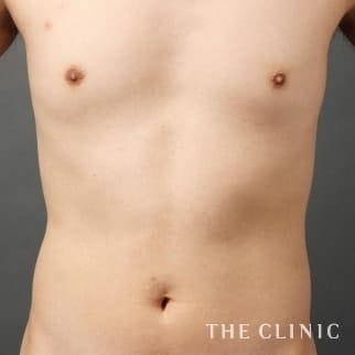 SIXPACK 陰影のある腹筋のベイザー4Dスカルプトのモニター（男性34歳）術前症例画像