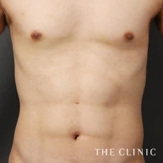 SIXPACK 陰影のある腹筋のベイザー4Dスカルプトのモニター（男性34歳）術後症例画像