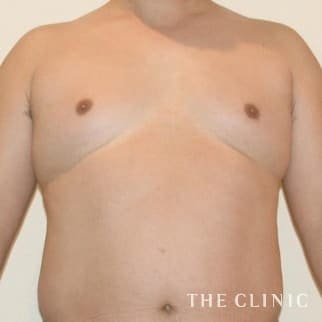 女性化乳房のベイザーのモニター(男性47歳)術前症例画像