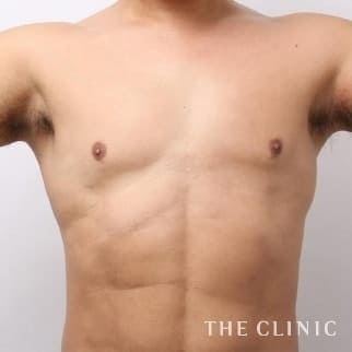 女性化乳房のベイザーのモニター（男性47歳）術後症例画像