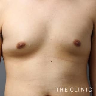 女性化乳房のベイザーのモニター(男性23歳)術前症例画像