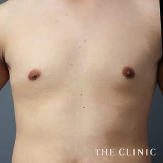 女性化乳房のベイザーのモニター（男性23歳）術後症例画像