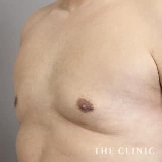 女性化乳房のベイザーのモニター（男性41歳）術後症例画像