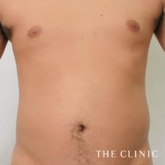 腹部のベイザーのモニター（男性31歳）術前症例画像