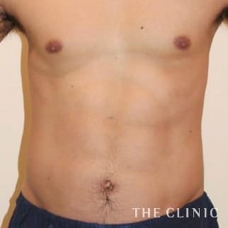 腹部のベイザーのモニター（男性31歳）術後症例画像