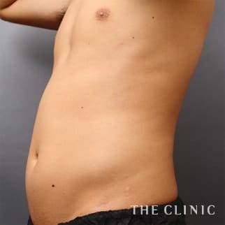 腹部のベイザーのモニター（男性31歳）術前症例画像