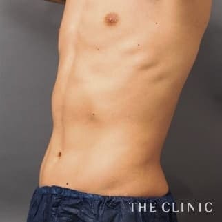 腹部のベイザーのモニター（男性31歳）術後症例画像