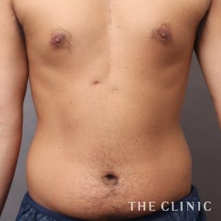 SIXPACK 陰影のある腹筋のベイザー4Dスカルプトのモニター（男性28歳）術前症例画像