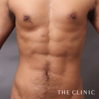 SIXPACK 陰影のある腹筋のベイザー4Dスカルプトのモニター（男性28歳）術後症例画像