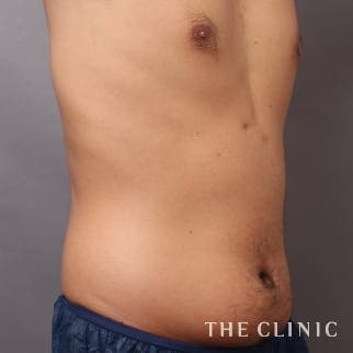 SIXPACK 陰影のある腹筋のベイザー4Dスカルプトのモニター(男性28歳)術前症例画像