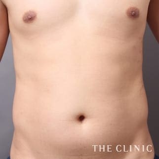 腹部のベイザーのモニター(男性32歳)術前症例画像