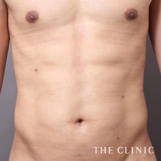 腹部のベイザーのモニター（男性32歳）術後症例画像