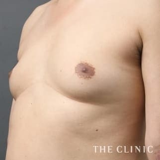 女性化乳房のベイザーのモニター(男性41歳)術前症例画像