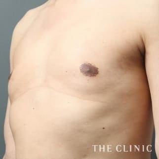 女性化乳房のベイザーのモニター（男性41歳）術後症例画像
