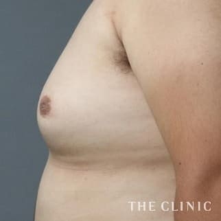 女性化乳房のベイザーのモニター(男性26歳)術前症例画像