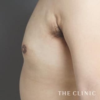 女性化乳房のベイザーのモニター（男性26歳）術後症例画像