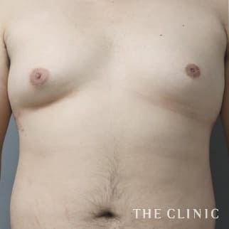 女性化乳房のベイザーのモニター(男性26歳)術前症例画像