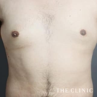 女性化乳房のベイザーのモニター（男性26歳）術後症例画像