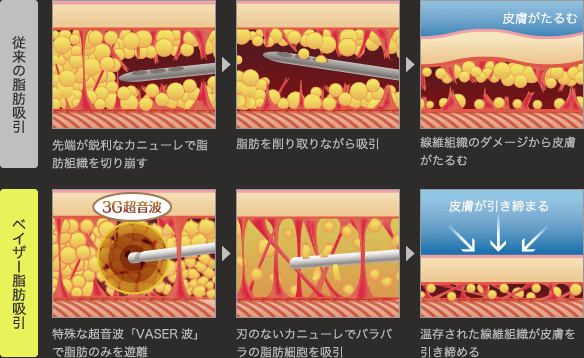 ベイザー脂肪吸引なので、術後の引き締め効果が期待できます。