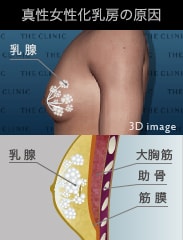 女性のバストと同じように乳腺自体が発達して胸が膨らんでしまう症状です。乳腺の周りには皮下脂肪も増加しています。