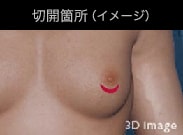 通常、乳輪直下を三日月状に切開します。