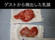 9cm(上)、7cm(下)とかなり大きな乳腺でしたが、切開箇所の大きさは3.5cmでした。