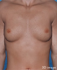 生まれつきの偽性女性化乳房