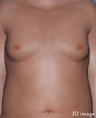 肥満による偽性女性化乳房