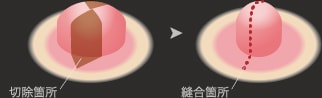 側面の一部を切除して、乳頭の中心を縫合します。