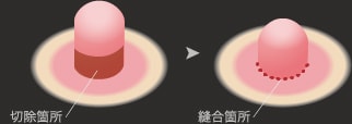 水平に切除して、乳頭の付け根部分を縫合します。