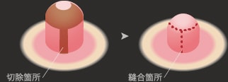 高さと大きさを調整して切除し、切開部分を縫合します。