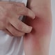 アトピー性皮膚炎